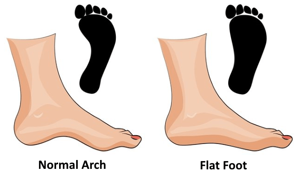 Flat foot store fix