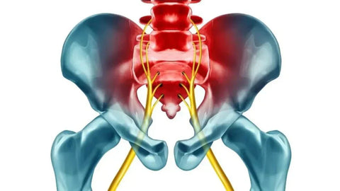 The #1 Cause of Sciatica