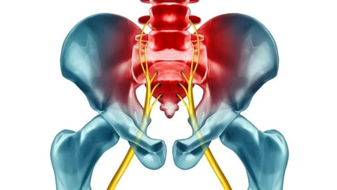 The #1 Cause of Sciatica